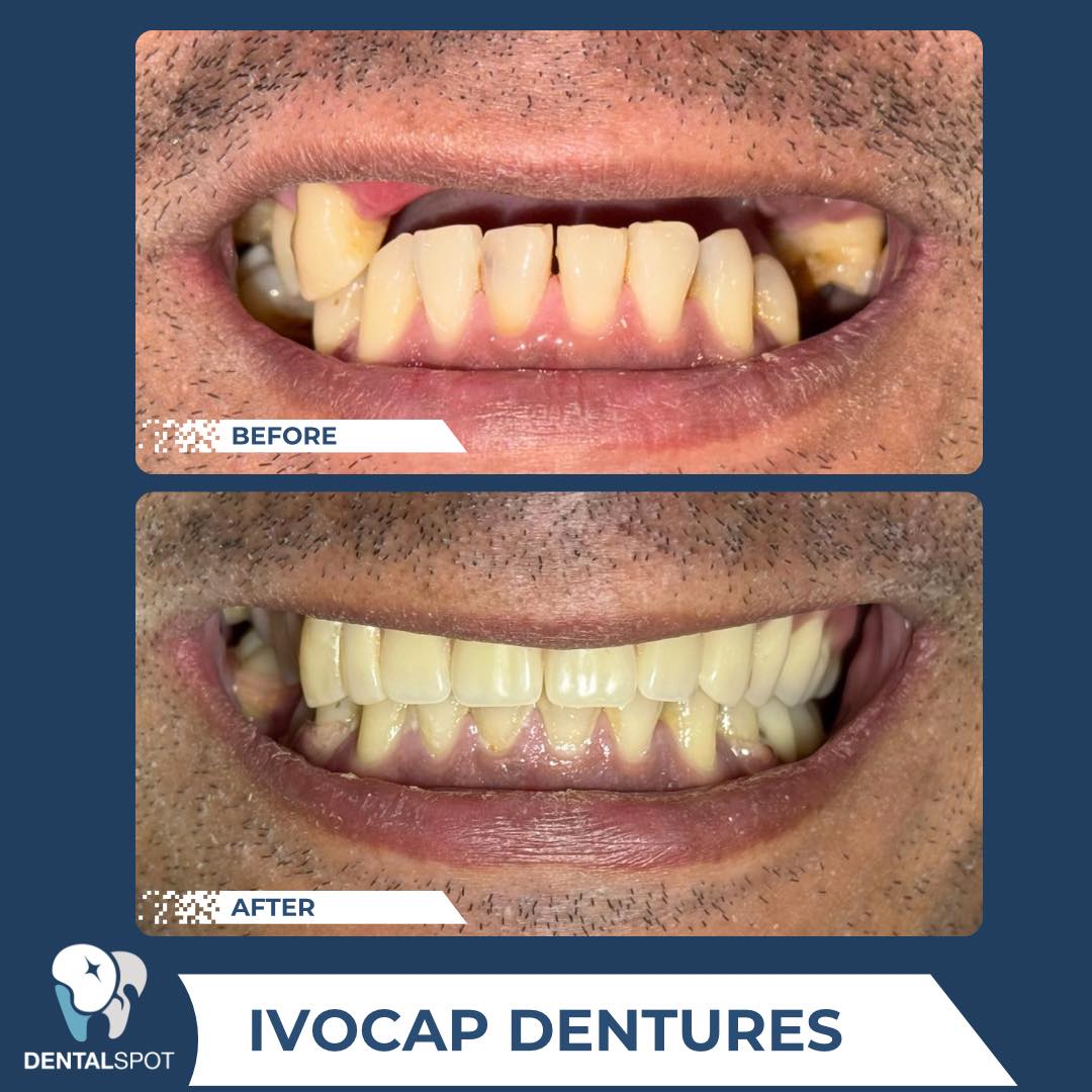 Before and After